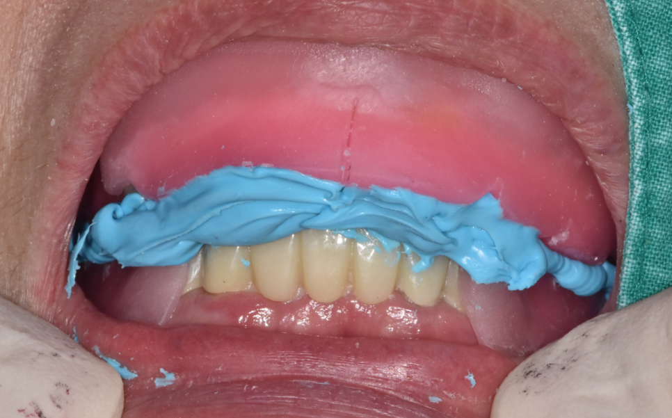 전체적인 치아 치료 13개의 임플란트를 식립한 환자분 관련 이미지 12