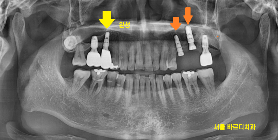 상일동 치과 잇몸 내려감 치료는 임플란트로 관련 이미지 8