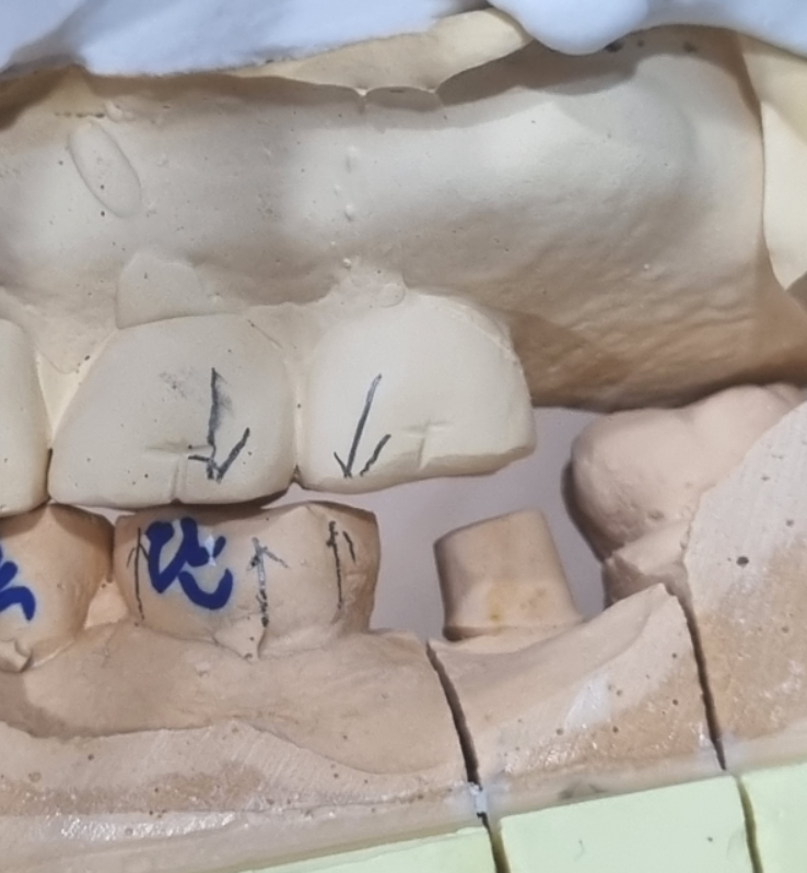 천호동 치과 충치로 인하여 손상된 치아 임플란트로 대처하기 관련 이미지 6