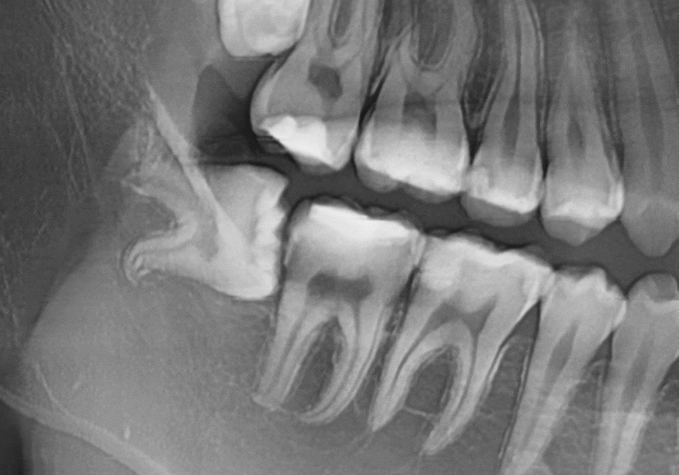 고덕동 사랑니 매복 발치, 안 아픈데 꼭 빼야 하나요? 관련 이미지 17