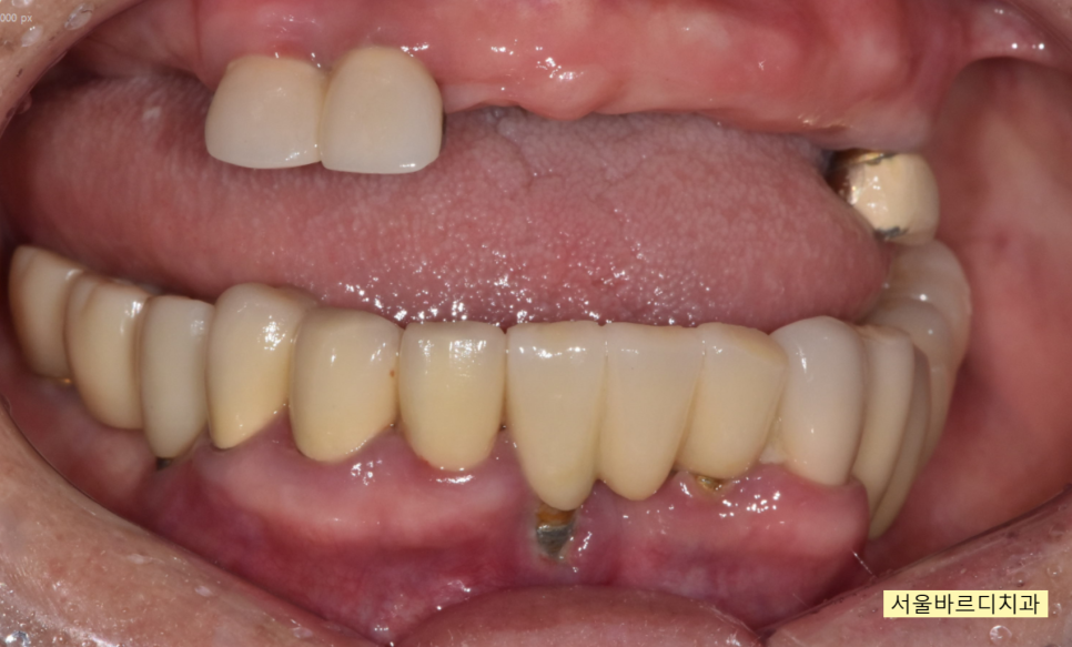 상일동 치과 부분 틀니에서 임플란트 바꿔서 사용하기 관련 이미지 7