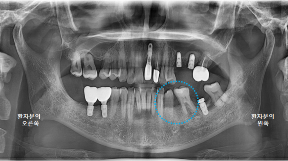 고덕동치과 서울바르디치과 전치부 및 구치부 임플란트 치료증례 #9 관련 이미지 28