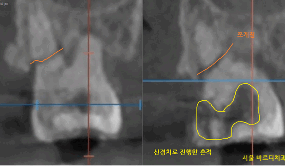미사역 치과 어금니 뿌리 쪼개짐으로 발치 후 임플란트 했습니다! 관련 이미지 1
