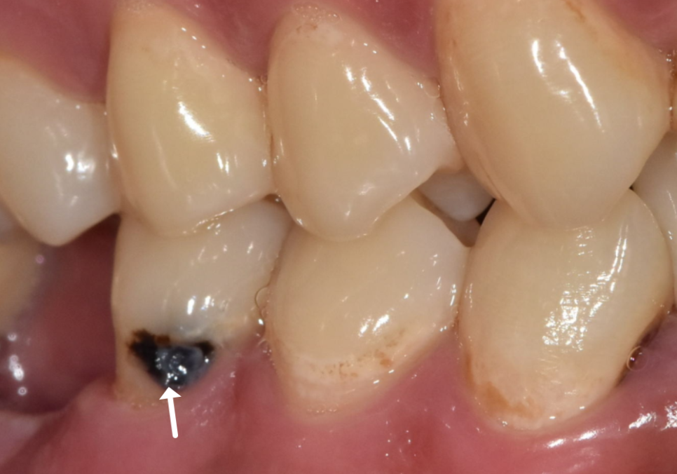 A Single Black Spot of Decay Between the Front Teeth May Be a Warning Sign of Multiple Cavities. image 3