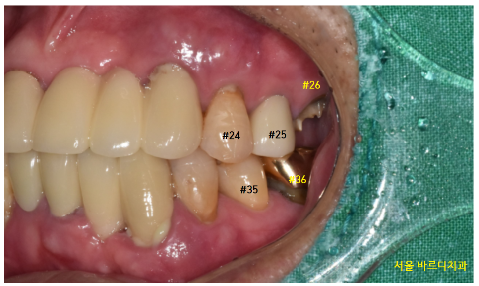 암사동 치과 임플란트 꼭 안 해도 되는 경우 궁금증 해결해 드려요 관련 이미지 13