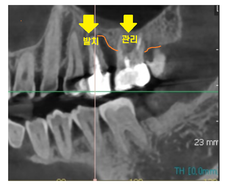 덕풍동 치과 씹을때 통증 임플란트로 극복했습니다. 관련 이미지 6