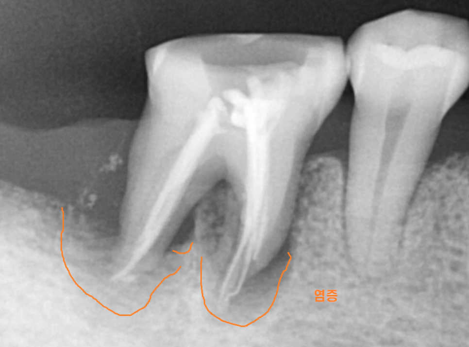 고덕동 임플란트 골이식 필수일까? 궁금증 여기 모두 있어요 관련 이미지 2