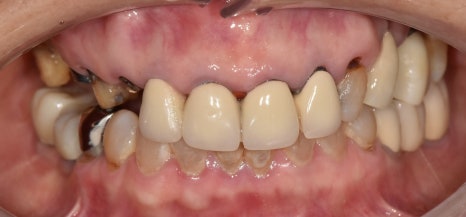 A Case of a 69-Year-Old Who Underwent Immediate Implant Placement After Extraction Due to Tooth Decay in Godeok-dong image 6
