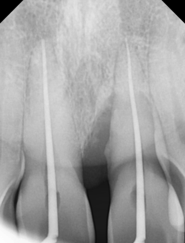잇몸 내려감으로 길어진 치아, 방치하면 안 되는 원인, 증상, 이유 관련 이미지 9
