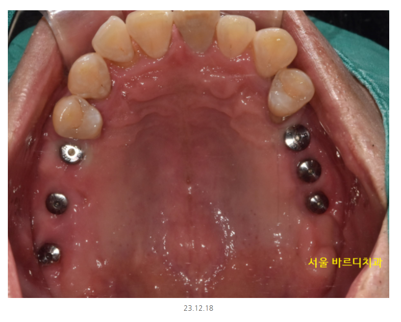 길동 치과 임플란트 뼈이식 흡연 관련 있을까? 관련 이미지 10