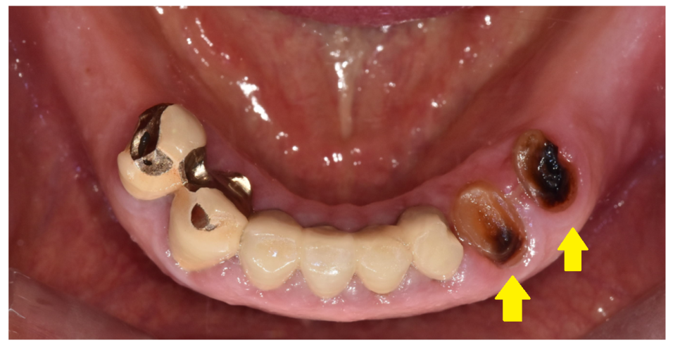 치아 크라운 빠짐 내부 충치가 심할때는 임플란트가 필요합니다. 관련 이미지 4