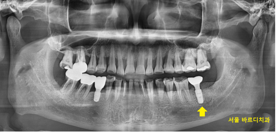 어금니 금감 발치 후 임플란트 풍산동 치과에서 진행했습니다. 관련 이미지 10