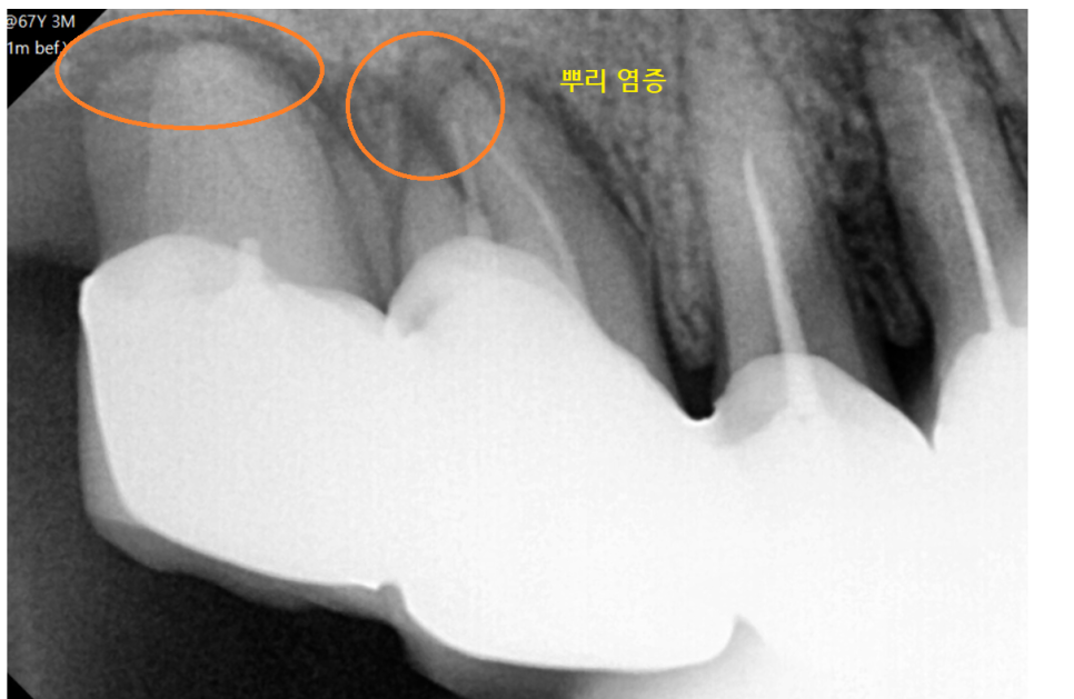 명일동 치과 뿌리 염증으로 입냄새가 나요 해결책은? 관련 이미지 4