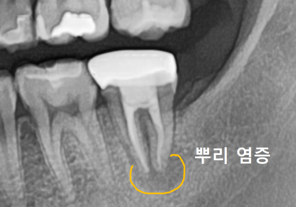 어금니 염증, 자연치 살리기에 진심인 저는 이렇게 살렸습니다. 관련 이미지 6