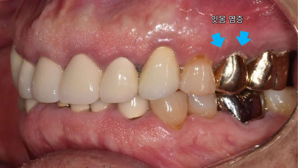 서울바르디치과 뿌리 끝 염증 심한 치아를 네비게이션 임플란트 #6 관련 이미지 2