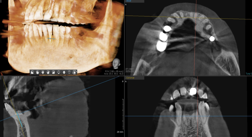 Restored 3 Teeth with Implants After Lower Front Teeth Became Loose and Fell Out image 5