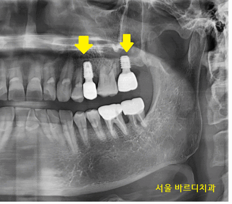 덕풍동 치과 임플란트 불가 판정받으신 환자분 살렸습니다. 관련 이미지 1