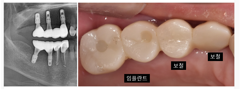 치아 닿기만 해도 아픔 원인은?? 해결은 이렇게 했습니다 관련 이미지 9
