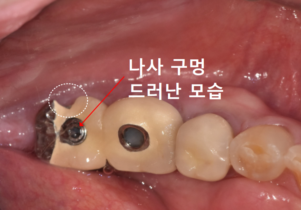 애써 심어둔 임플란트, 교체해야 된다구요? 냄새가 난다면 확인해보세요. 관련 이미지 5