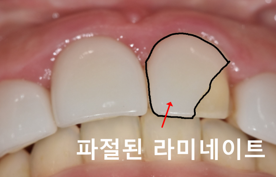 라미네이트 깨짐 원인 TOP 3, <대표원장>이 직접 알려드립니다 관련 이미지 2