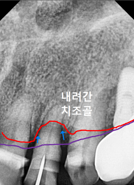 고덕역치과, 잇몸 패임(치경부 마모) 레진 치료, 왜 자꾸 떨어지나요? 관련 이미지 7