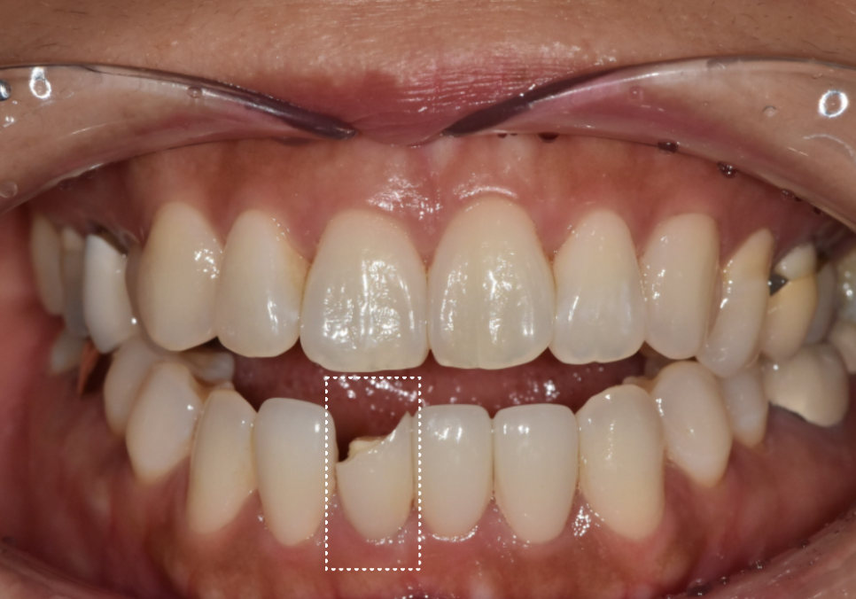 앞니 라미네이트 교체, 재시술 전 꼭 알아야 할 실패를 줄이는 방법 관련 이미지 5