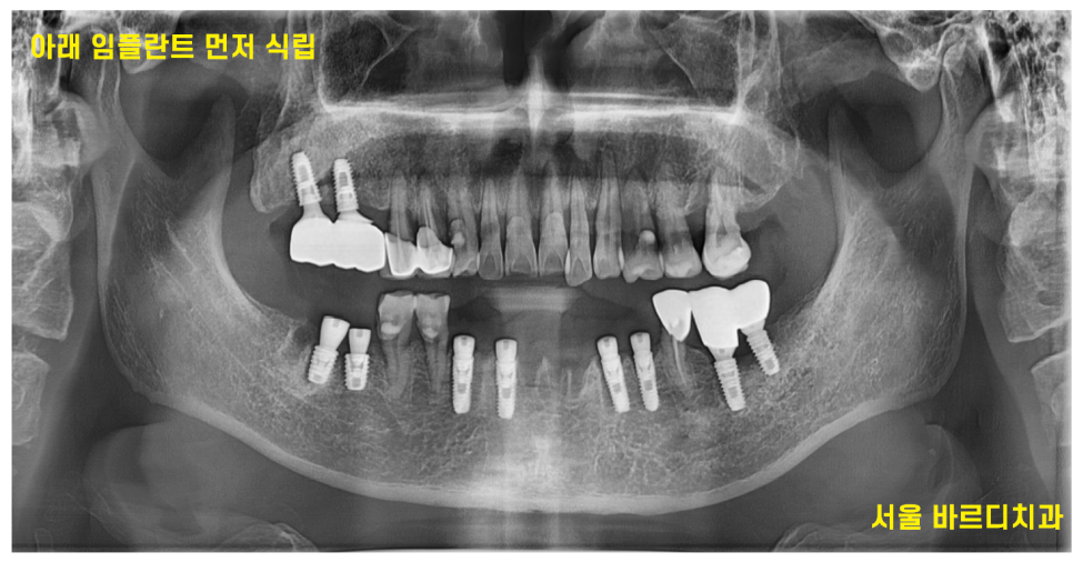 녹아버린 잇몸뼈 흔들리는 여러 치아 발치 후 임플란트 시행 관련 이미지 7