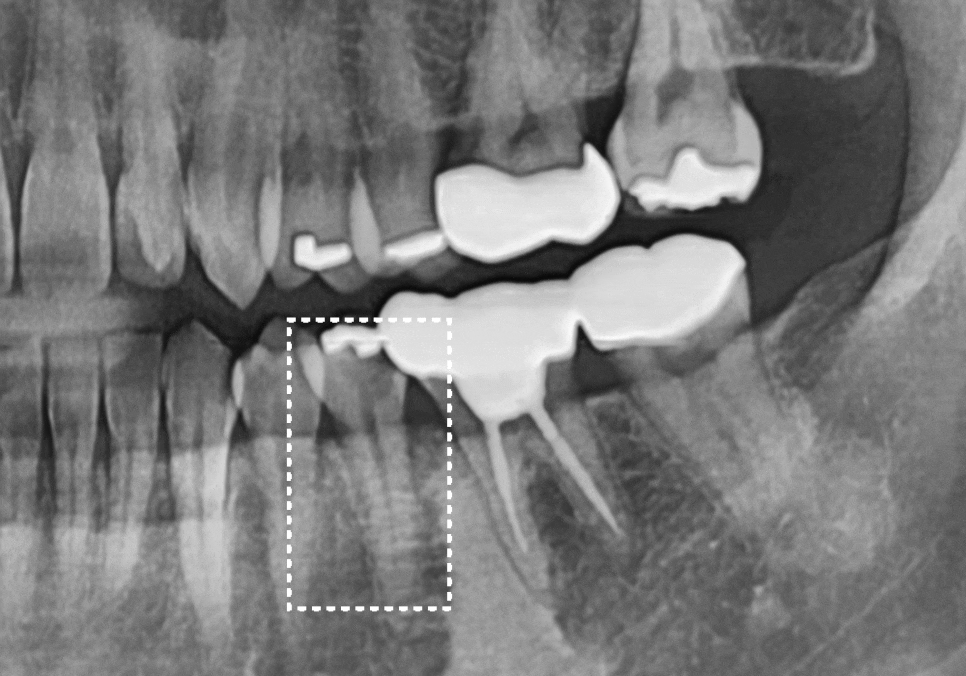 아말감 파절, 조금 깨졌을 뿐인데, 2차 충치로 치아 절반이 깨진 사연 관련 이미지 13