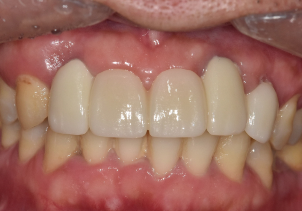 앞니 브릿지 부러짐, 이런 상태라면 절대 브릿지 다시 하지 마세요. 관련 이미지 14