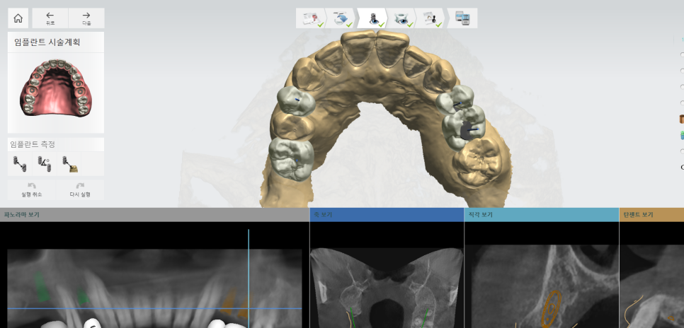 네비게이션 임플란트가 왜 좋다고 그러는거죠? (feat.13가지 장점) 관련 이미지 6