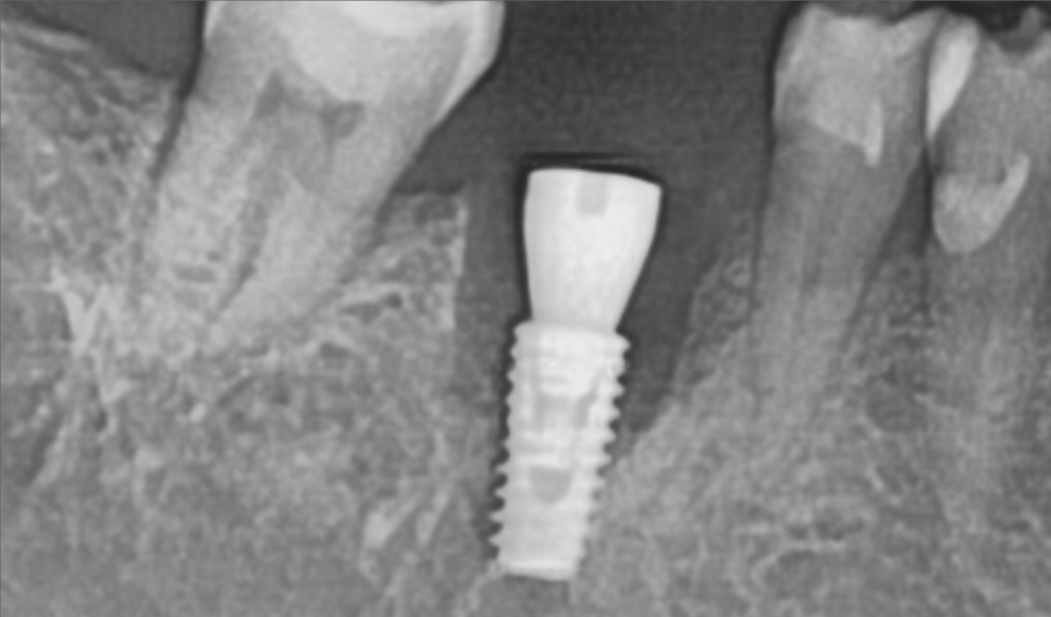 바르디 임플란트는 바르게 심지만, 빠르게 씹습니다. 그간의 경험을 바탕으로요. 관련 이미지 12