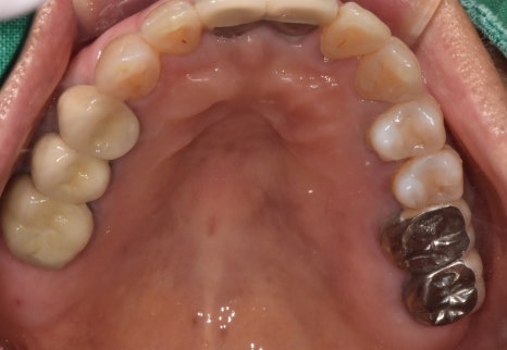 Godok Implant: Treatment That Reduced the Financial Burden with Insurance Implants for a Patient in Their 70s image 4