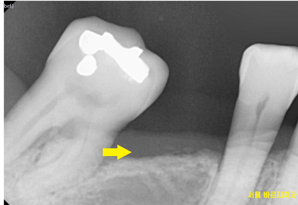 고덕역 치과 빠진 어금니 방치 그대로 두다가는 임플란트가..? 관련 이미지 3