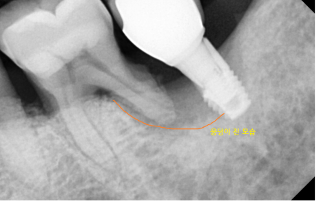 고덕동 치과 임플란트 뼈이식 꼭 해야하는건가요? 관련 이미지 5