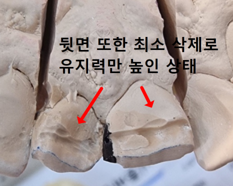 앞니 덧니, 교정은 싫고 시간은 없다면? 라미네이트로 해결한 사례 관련 이미지 11
