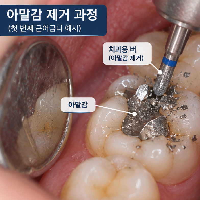 아말감 2차 충치, 안 아파도 교체해야 할 때가 있습니다 관련 이미지 5