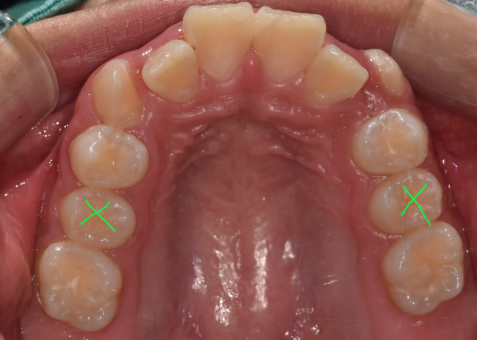 How to Correct a Canine Crowding Malocclusion: Extractions Are Necessary to Address Lip Protrusion image 6