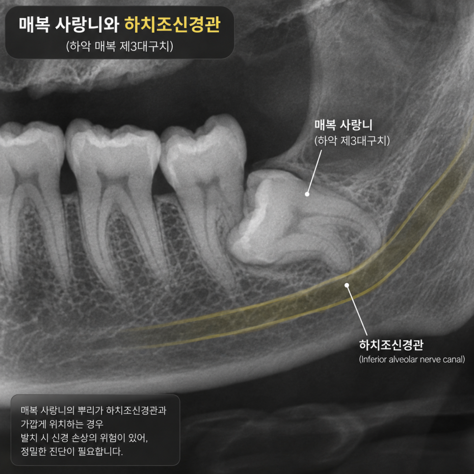 사랑니 발치 시기, 언제 빼야 유리할까? 관련 이미지 3
