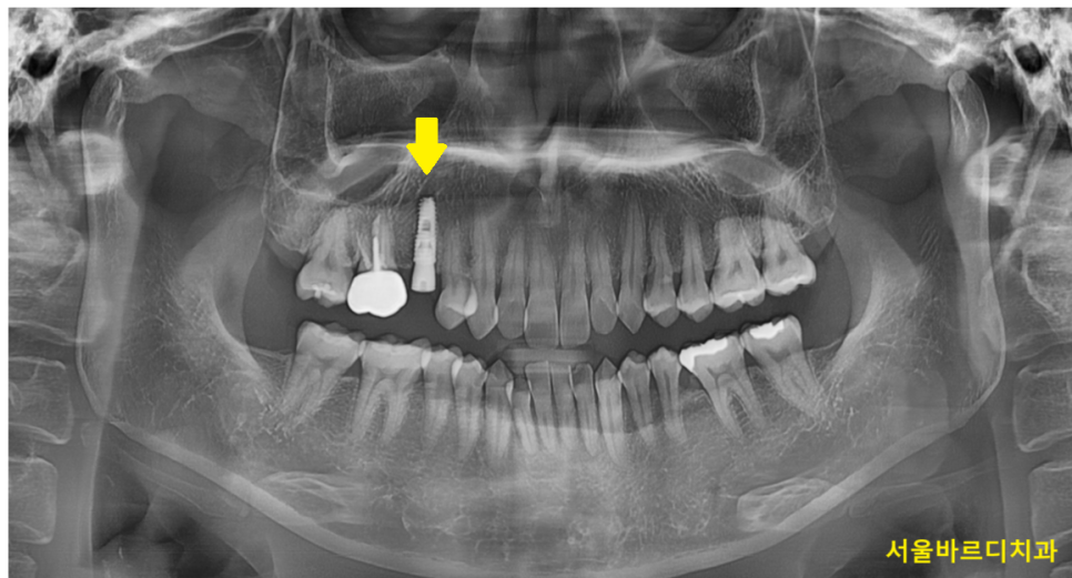 씌운 치아 부러짐 뿌리만 남은 경우 임플란트로 수복하기 관련 이미지 6
