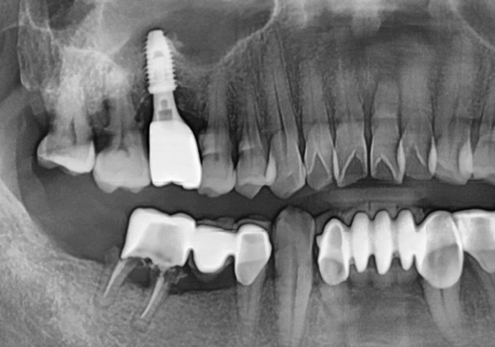 고덕동 어금니 브릿지 교체, 관련 이미지 10