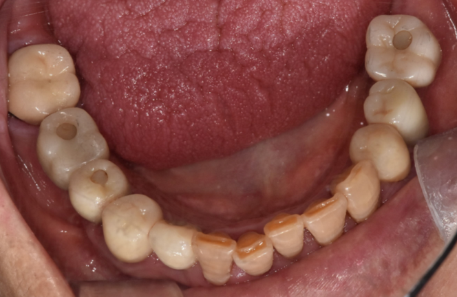 타치과 임플란트 as 수리 가능한 선동치과 관련 이미지 10