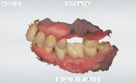 상일동 임플란트 상악동 거상술을 동반한 수술 증례 관련 이미지 13