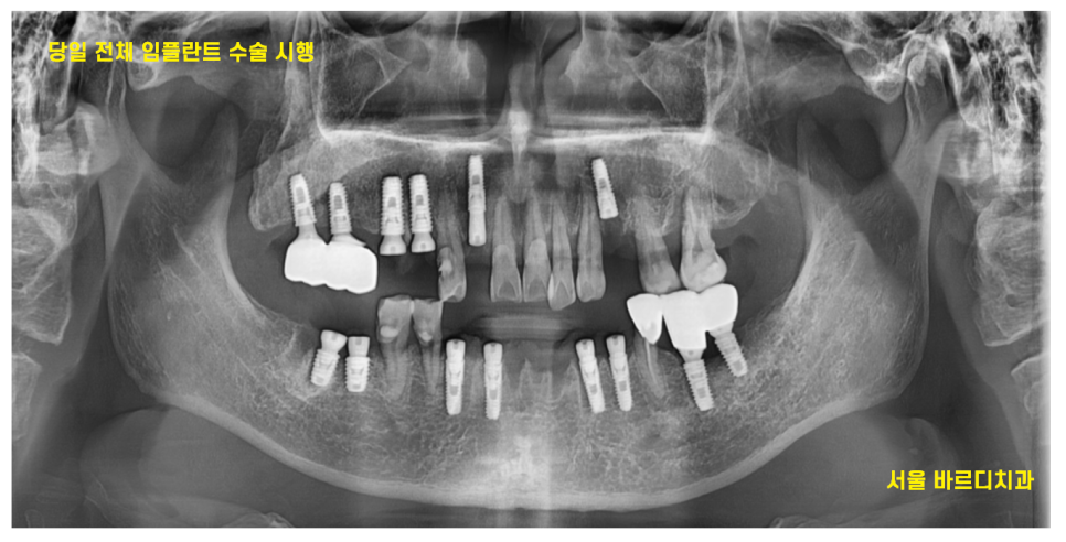 강일동 임플란트 위아래 치아 흔들림과 통증이 있을 때 방법은? 관련 이미지 7