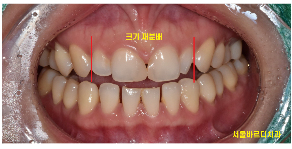 왜소치 라미네이트 작은 치아 콤플렉스 말끔하게 극복해요!! 관련 이미지 5