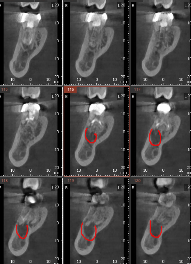 신경치료 염증 치아 다시 한번 치료하여 자연치아 살렸습니다. 관련 이미지 3