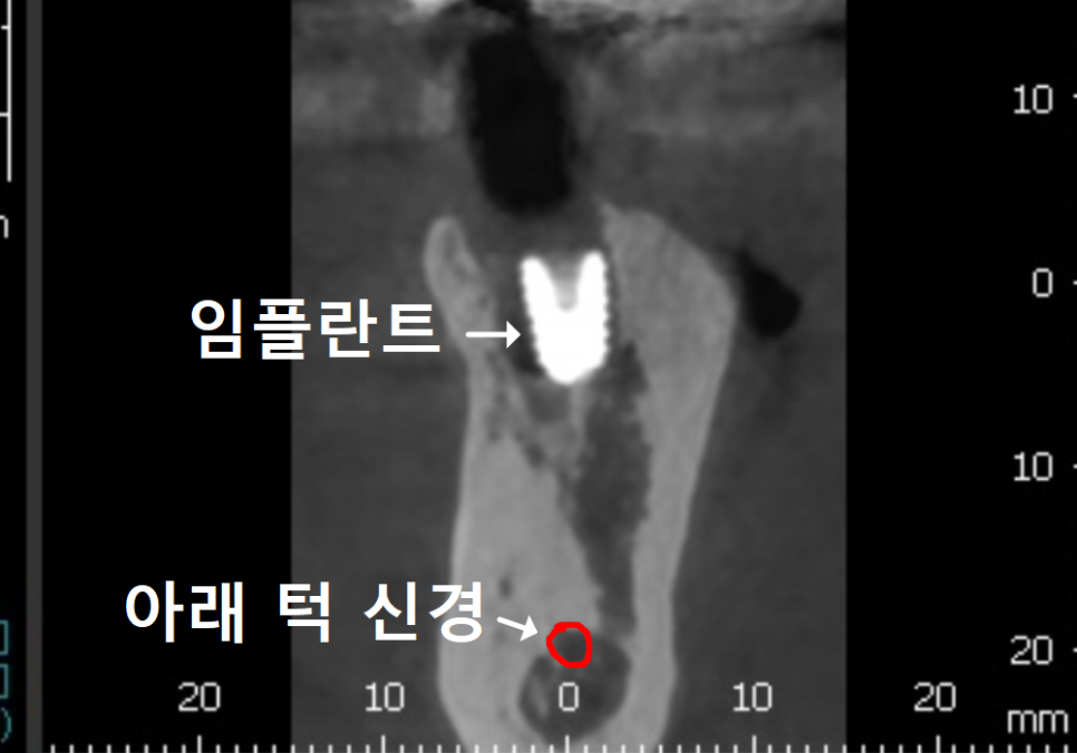 아말감 파절, 조금 깨졌을 뿐인데, 2차 충치로 치아 절반이 깨진 사연 관련 이미지 9