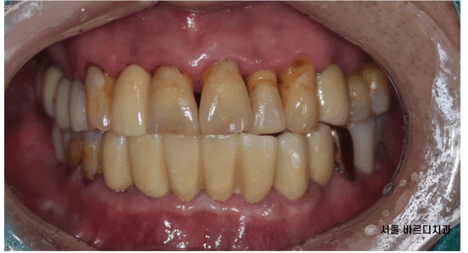 강일동 임플란트 위아래 치아 흔들림과 통증이 있을 때 방법은? 관련 이미지 1