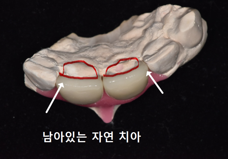 강일역 치과, 검게 보이는 앞니 레진 변색, 무조건 새로 해야 할까요? 관련 이미지 11