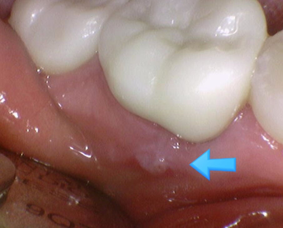 잇몸 물집 강일역 치과에서 원인 알아보고 임플란트로 치료했습니다. 관련 이미지 4