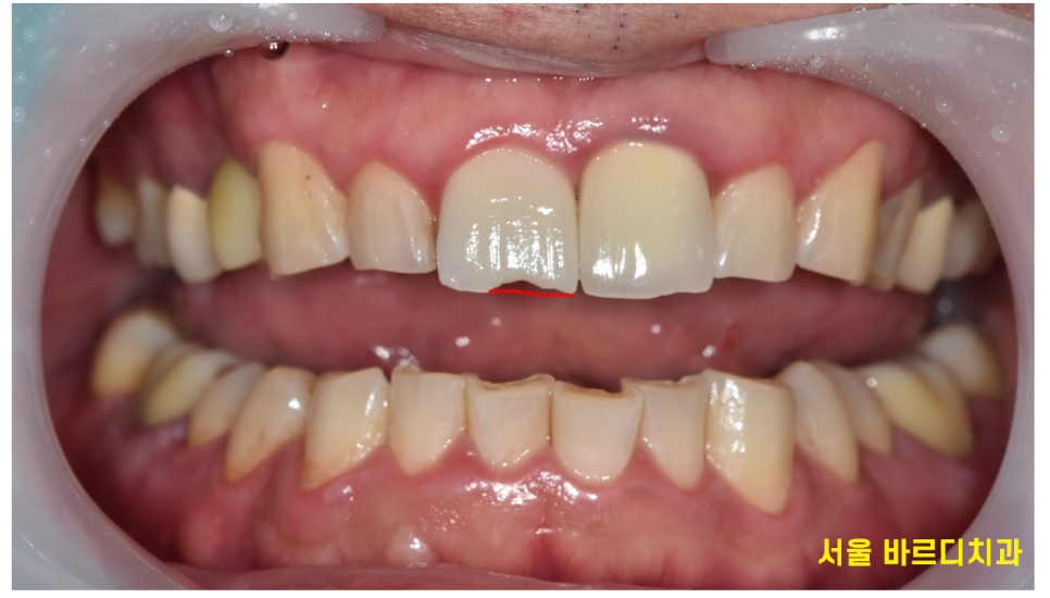 살짝 깨진 앞니 레진과 라미네이트 갈림길 어떤게 더 좋을까? 관련 이미지 6